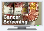 Preventing Colorectal Cancer